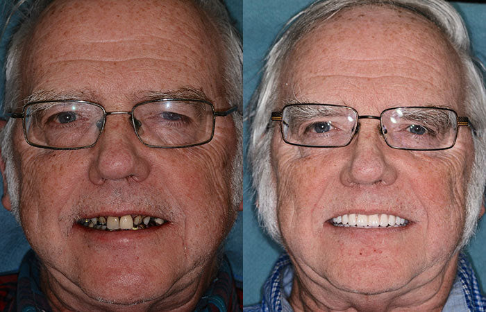 Personalized Complete Dentures – Authentic Ivory & White Smile