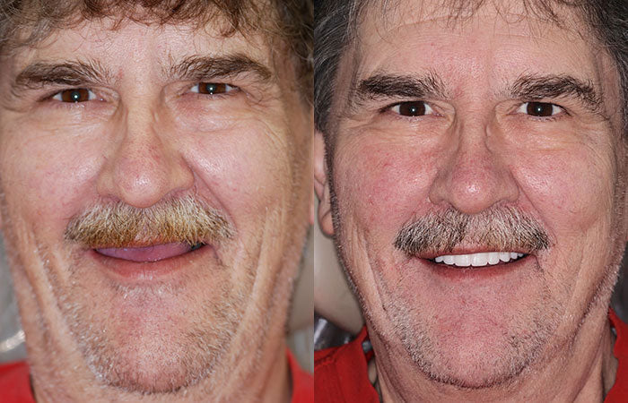 Personalized Complete Dentures – Authentic Ivory & White Smile