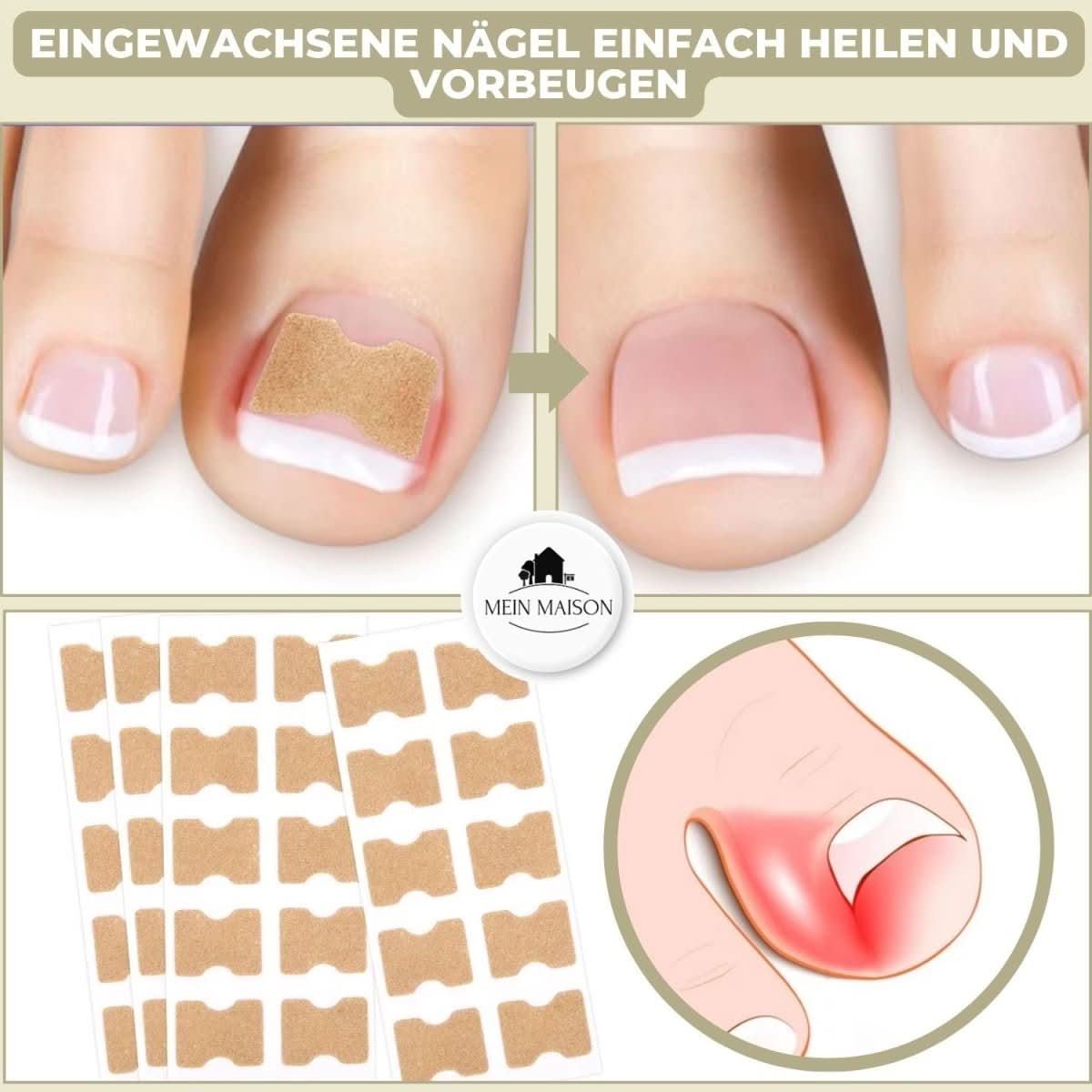 ComfortFit Nail Relief System for Ingrown Nails