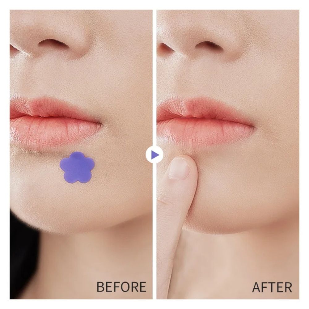 Acne Treatment Hydrocolloid Patches for Pimples