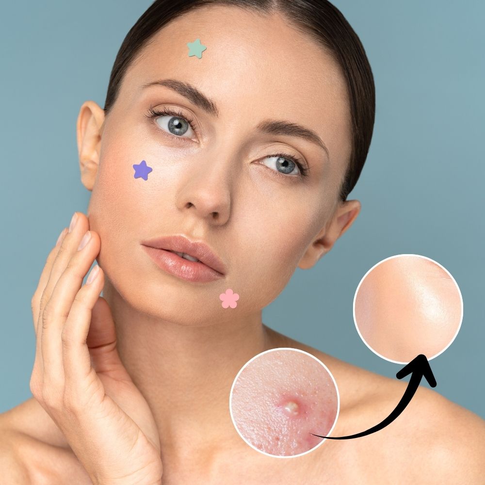 Acne Treatment Hydrocolloid Patches for Pimples