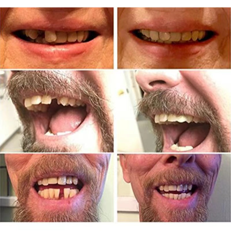 Affordable and Natural-Looking Temporary Tooth Replacement