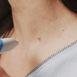 Skin Tag Removal Kit – Gentle Aero Tag Eliminator