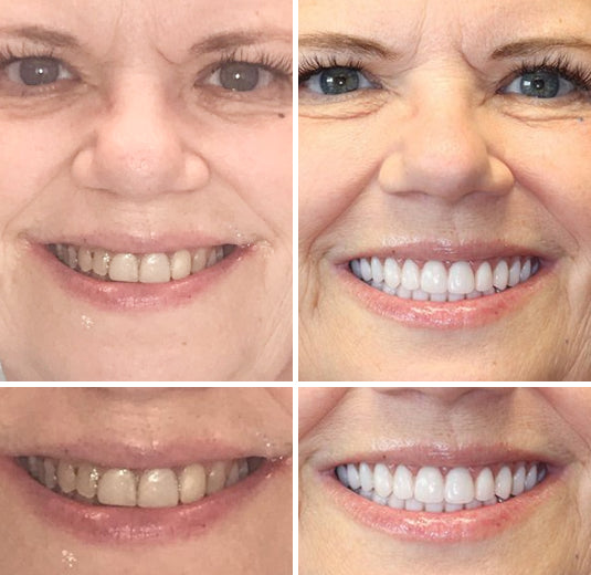 Full Denture Kit | Customized Fit for Natural Look | Comfortable Confidence Boost
