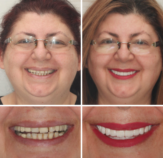 Full Denture Kit | Customized Fit for Natural Look | Comfortable Confidence Boost