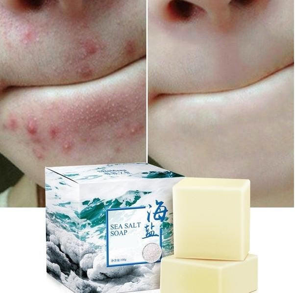 Acne Treatment Soap with Sea Salt
