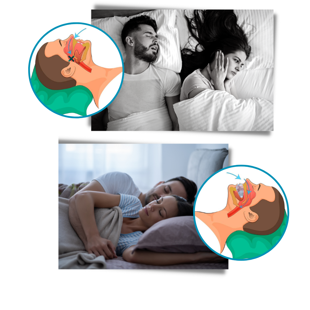 ComfortSmart Snore Relief Device