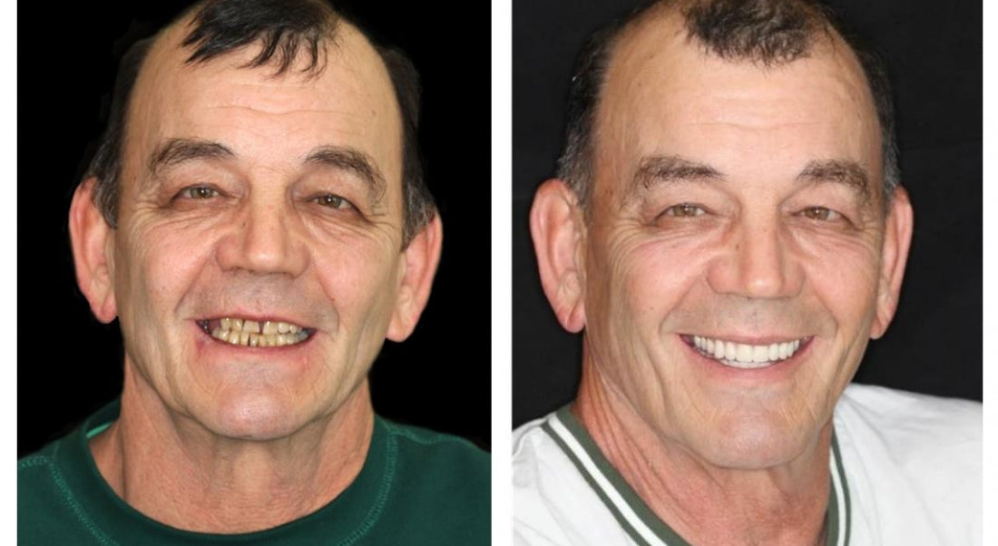 Personalized Complete Dentures – Authentic Ivory & White Smile