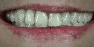 Custom-Fit Removable Veneers for Upper and Lower Teeth – Natural Smile Solution