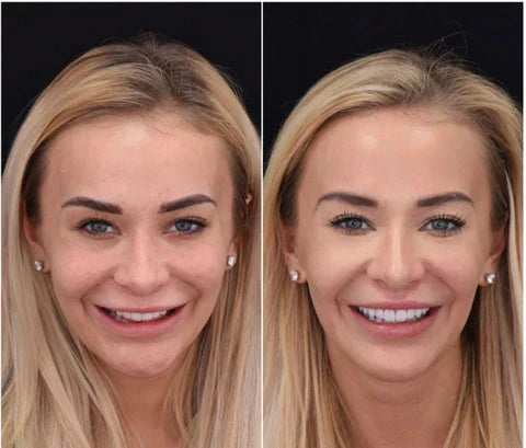 Custom-Fit Removable Veneers for Upper and Lower Teeth – Natural Smile Solution