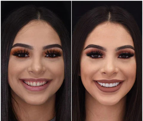 Custom-Fit Removable Veneers for Upper and Lower Teeth – Natural Smile Solution