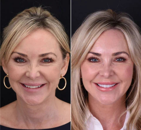 Custom-Fit Removable Veneers for Upper and Lower Teeth – Natural Smile Solution