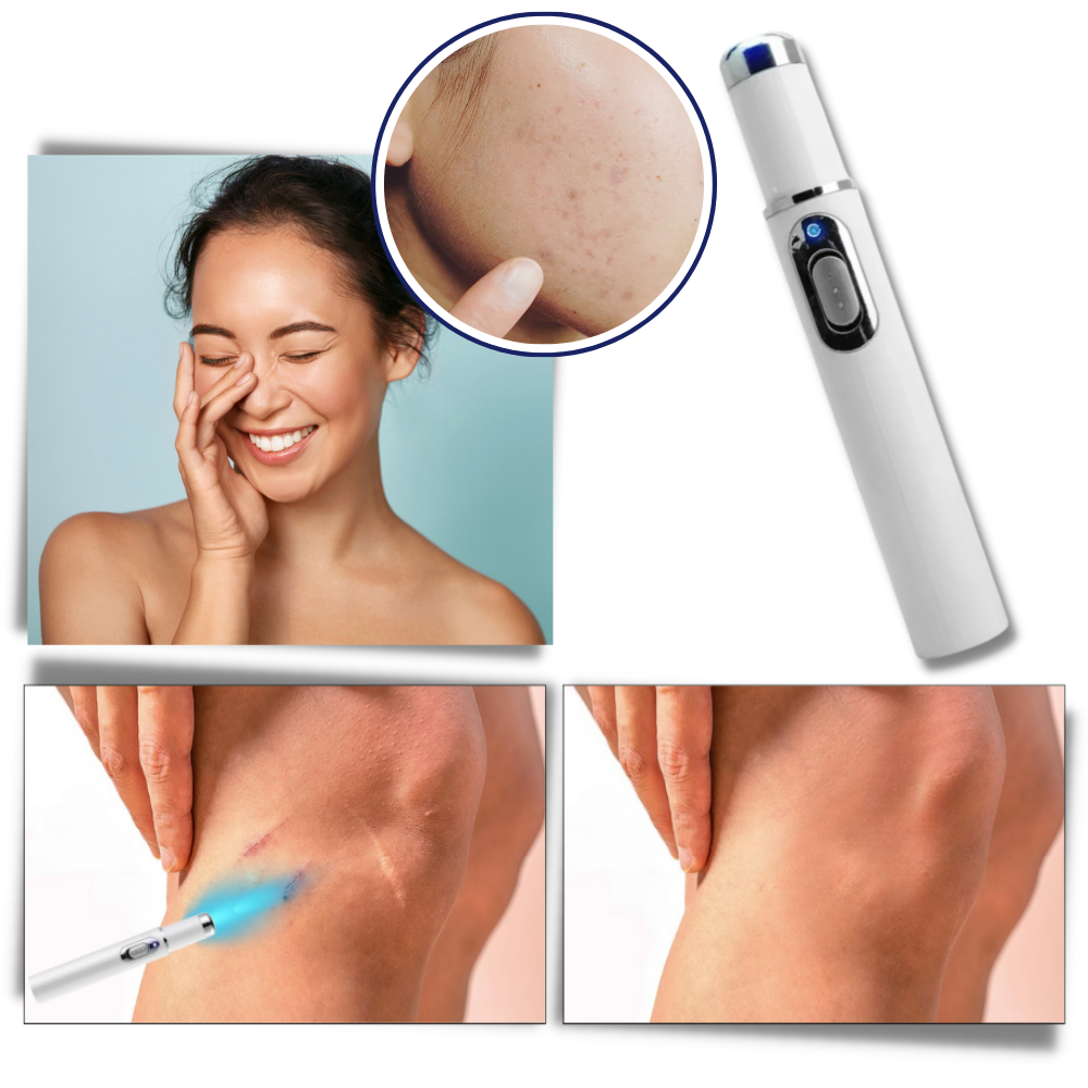 Portable Blue Light Skin Pen | Targeted Scar & Hyperpigmentation Treatment | Battery-Operated Travel Size