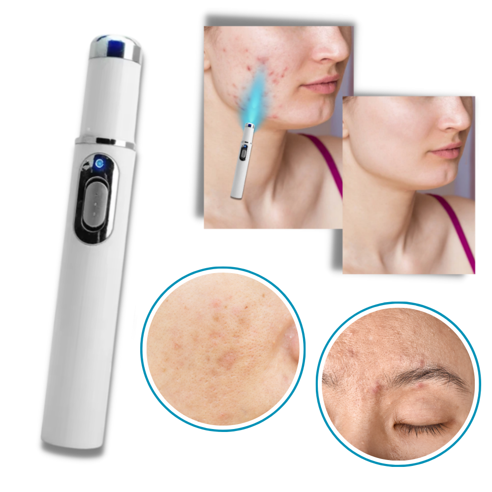 Portable Blue Light Skin Pen | Targeted Scar & Hyperpigmentation Treatment | Battery-Operated Travel Size