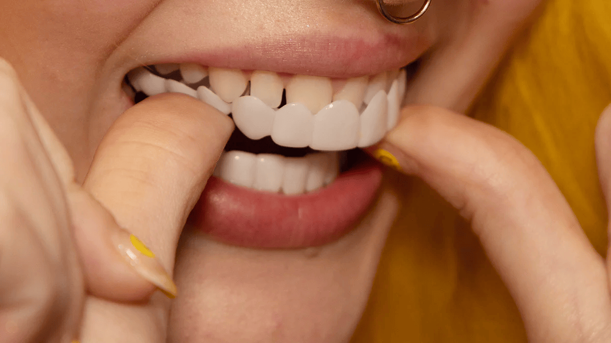 Removable Dental Veneers | Instant Smile | Custom Thermoform Fit & Reusable