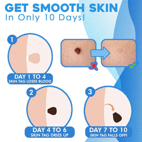 Skin Tag Removal Kit | Automatic Band Applicator | 44-Pack Bands & Remover Tools | Easy At-Home Use
