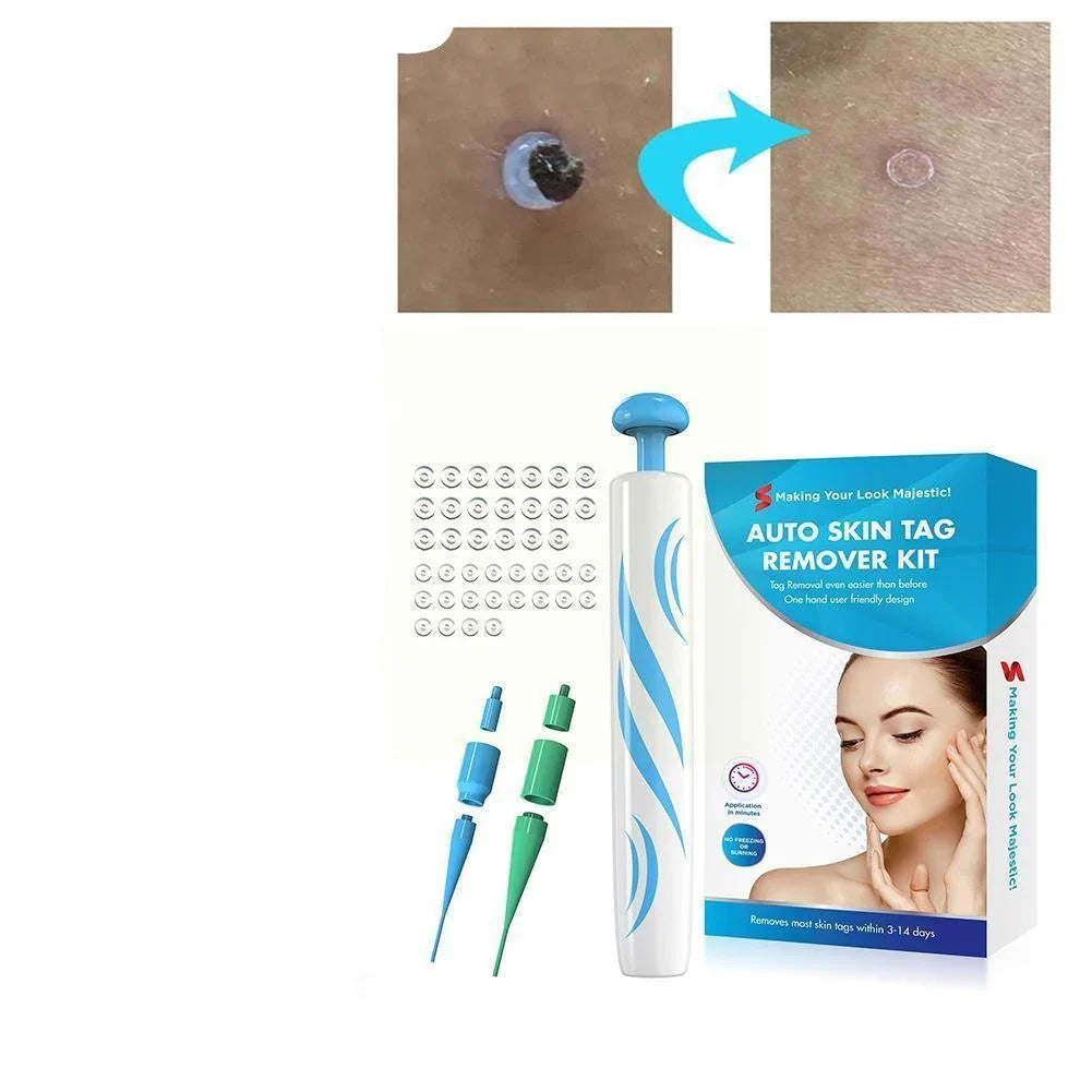 Painless Skin Tag Removal Device