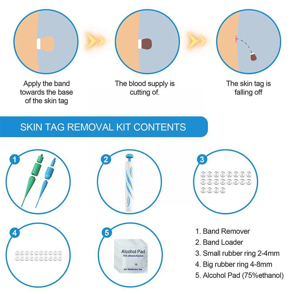 Painless Skin Tag Removal Device