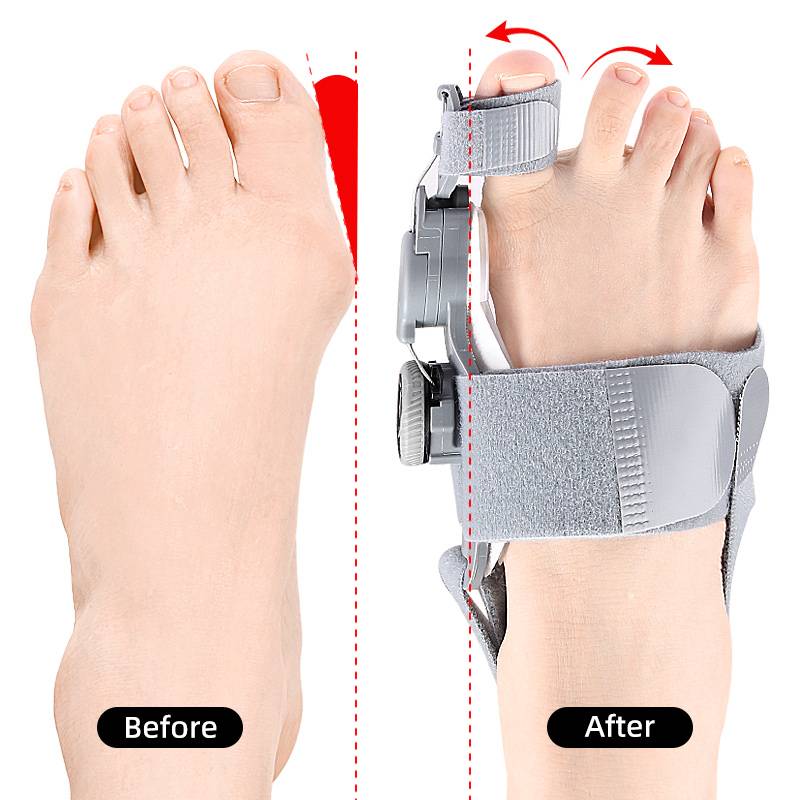 Toe Spacer for Natural Bunion Correction