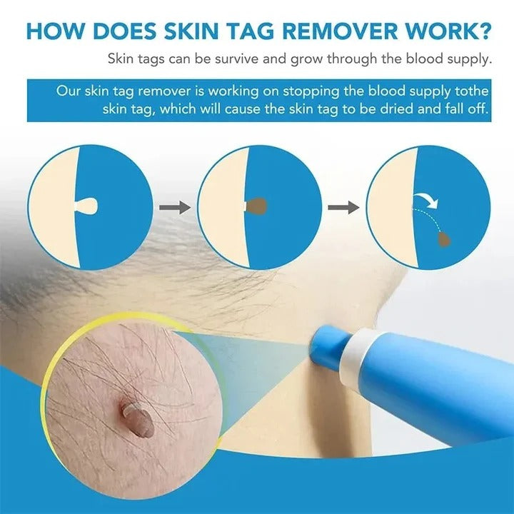 At-Home Skin Tag Removal System with Silicone Bands & Tool