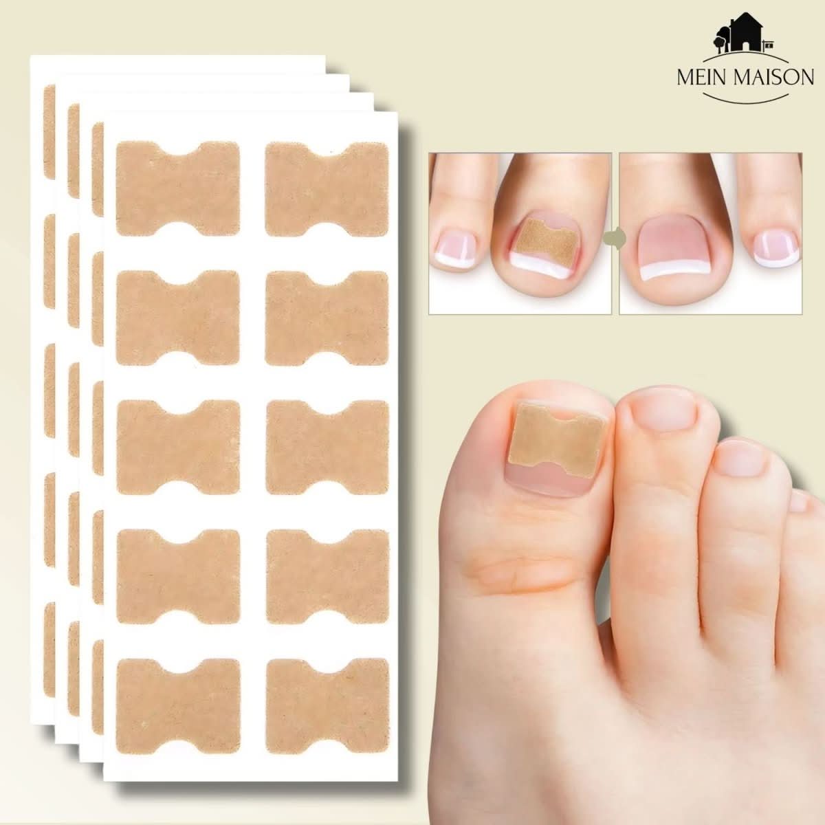 ComfortFit Nail Relief System for Ingrown Nails