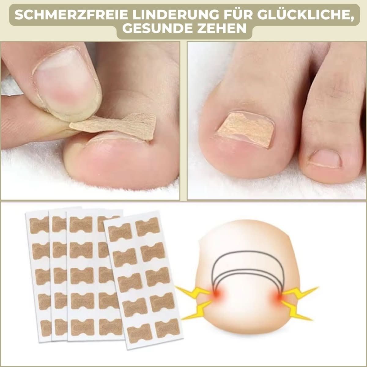 ComfortFit Nail Relief System for Ingrown Nails