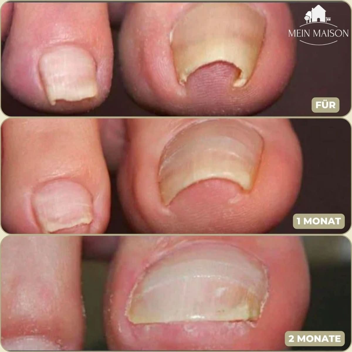 ComfortFit Nail Relief System for Ingrown Nails