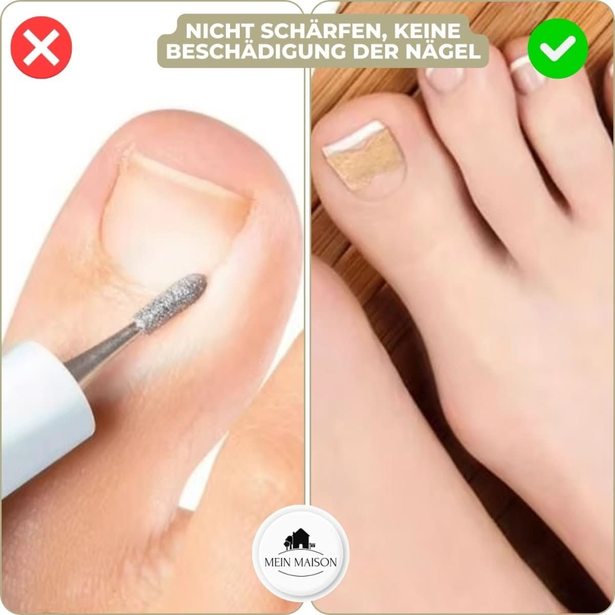 ComfortFit Nail Relief System for Ingrown Nails