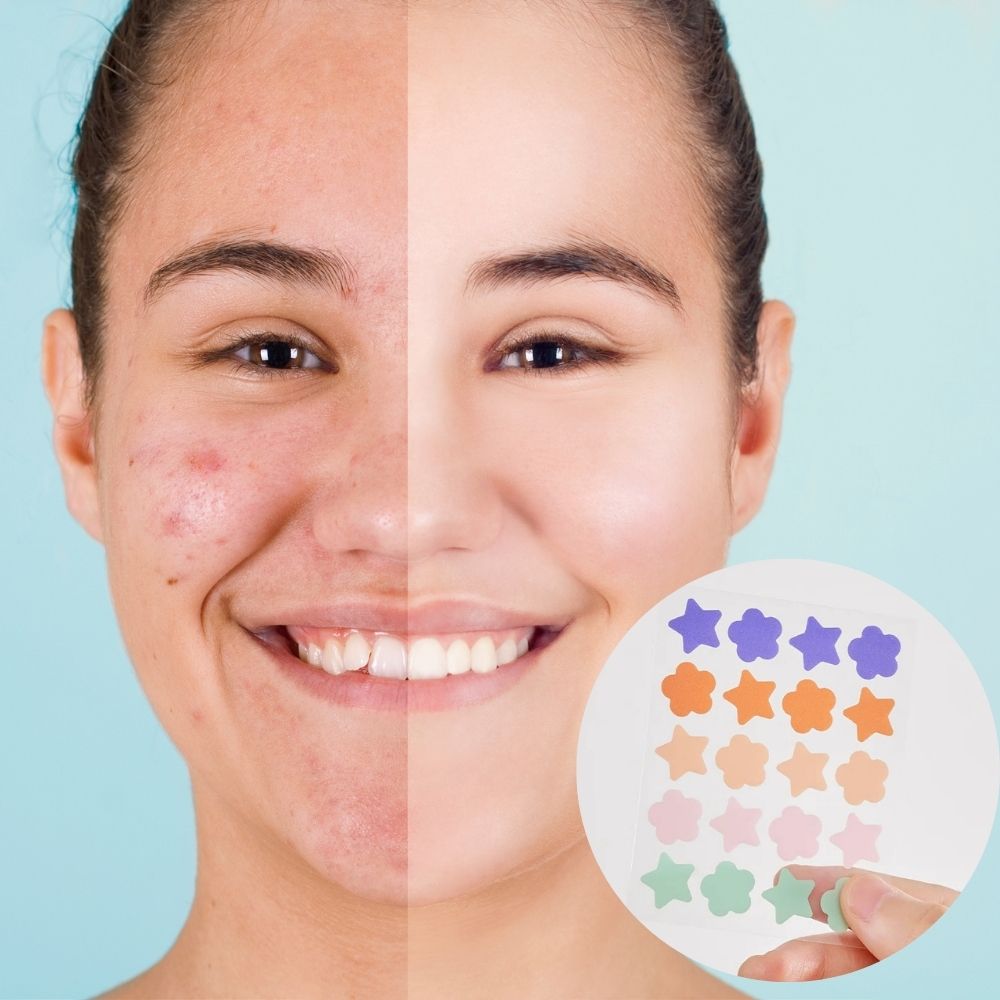 Acne Treatment Hydrocolloid Patches for Pimples