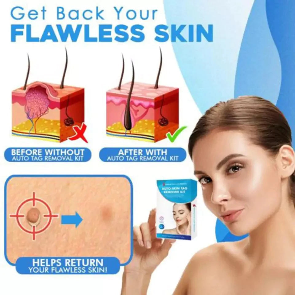 Skin Tag Removal Kit – Gentle Aero Tag Eliminator