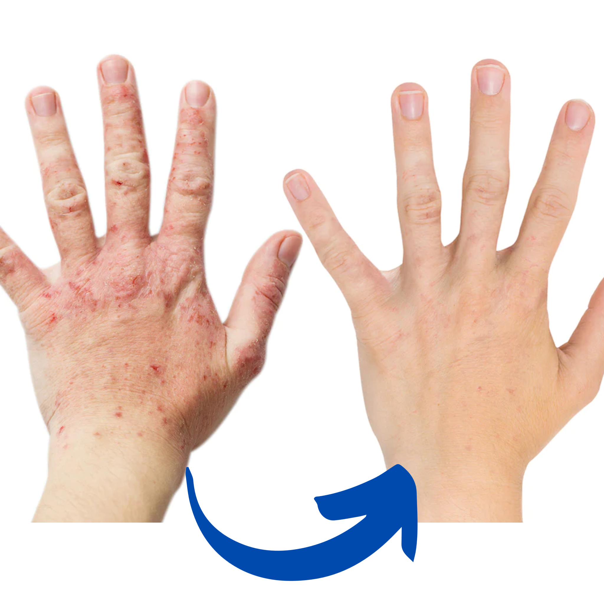 Infrared Therapy Gloves for Arthritis Relief – Ergonomic Design for Hand Function