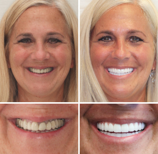 Full Denture Kit | Customized Fit for Natural Look | Comfortable Confidence Boost