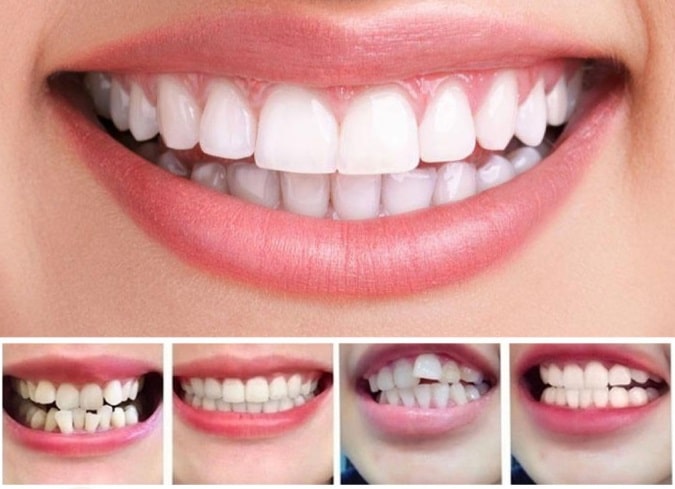 Clear Aligners for Teeth Straightening