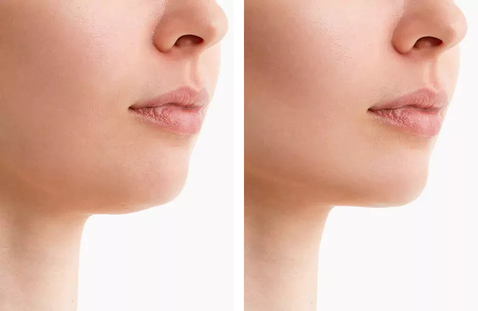 Portable Jaw Sculpting Belt for Red Light Therapy and Double Chin Slimming