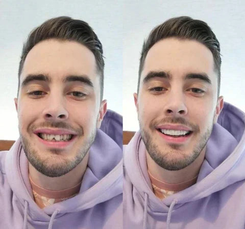 Custom-Fit Removable Veneers for Upper and Lower Teeth – Natural Smile Solution