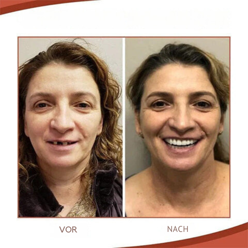 Denture Set | Biocompatible Silicone Prosthesis | Natural-Looking Teeth | Comfortable Fit
