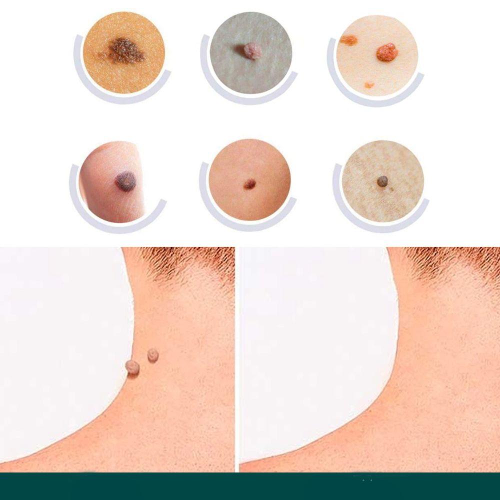 Skin Tag Patches | Hydrocolloid Plasters | 120 Count | Hypoallergenic Matte Finish