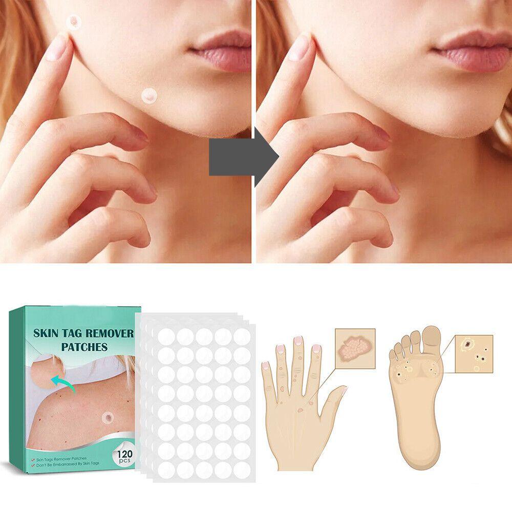 Skin Tag & Wart Patches | Painless & Discreet | 120-Pack