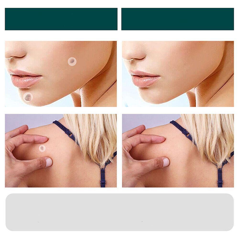 Skin Tag & Wart Patches | Painless & Discreet | 120-Pack