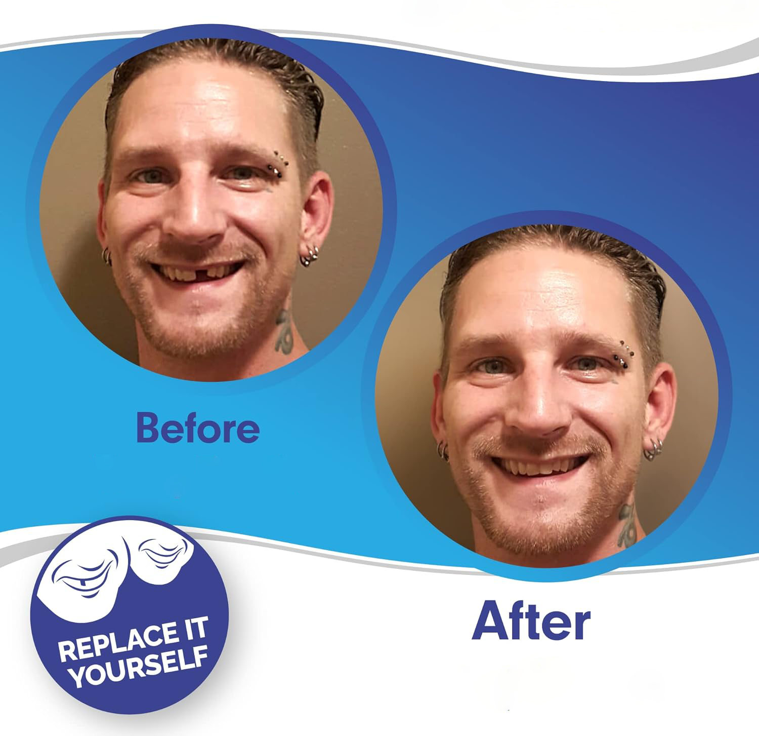 Snap-On Veneers (Upper & Lower) | Natural-Looking Finish | Silicone Liner | Comfortable Fit