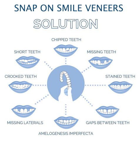 Snap-On Veneers (Upper & Lower) | Natural-Looking Finish | Silicone Liner | Comfortable Fit