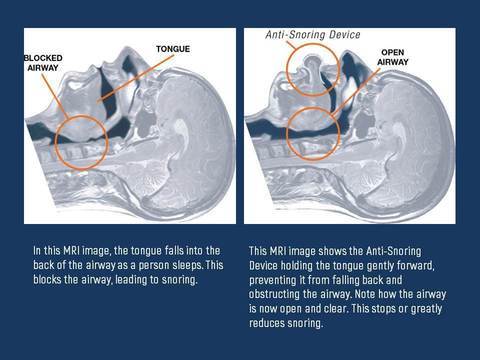 Tongue Stabilizing Device | Suction Anti-Snore Design | Medical-Grade Silicone & Comfortable Fit
