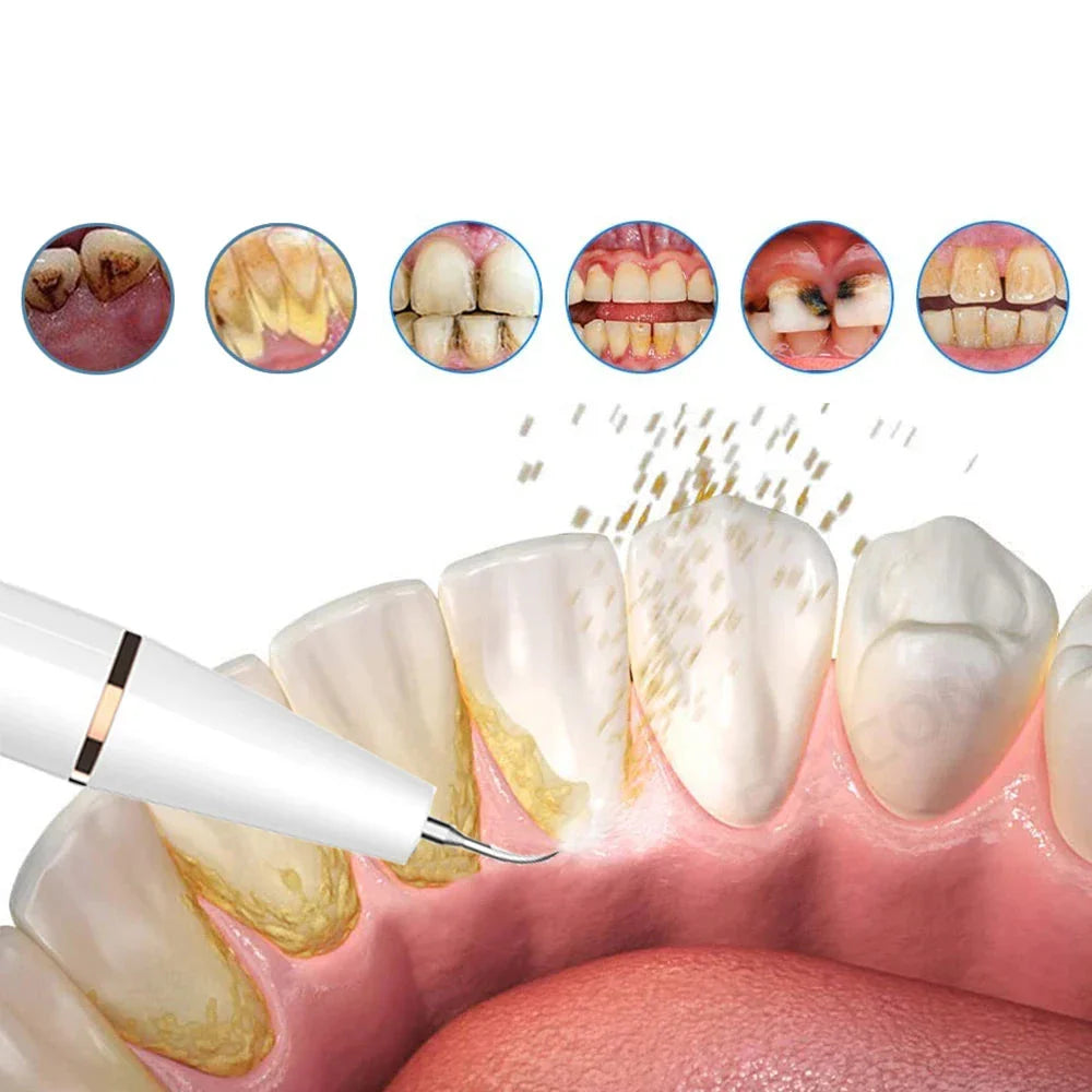 Rechargeable Ultrasonic Dental Cleaner – Ergonomic Teeth Stain Remover