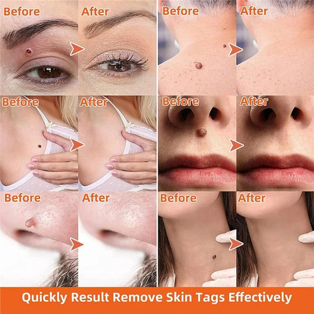 Painless Skin Tag Removal Device