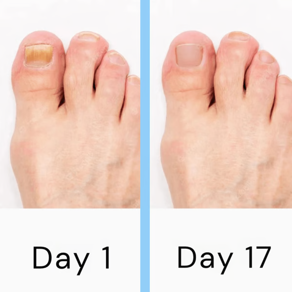 Laser Treatment Device for Nail Fungus