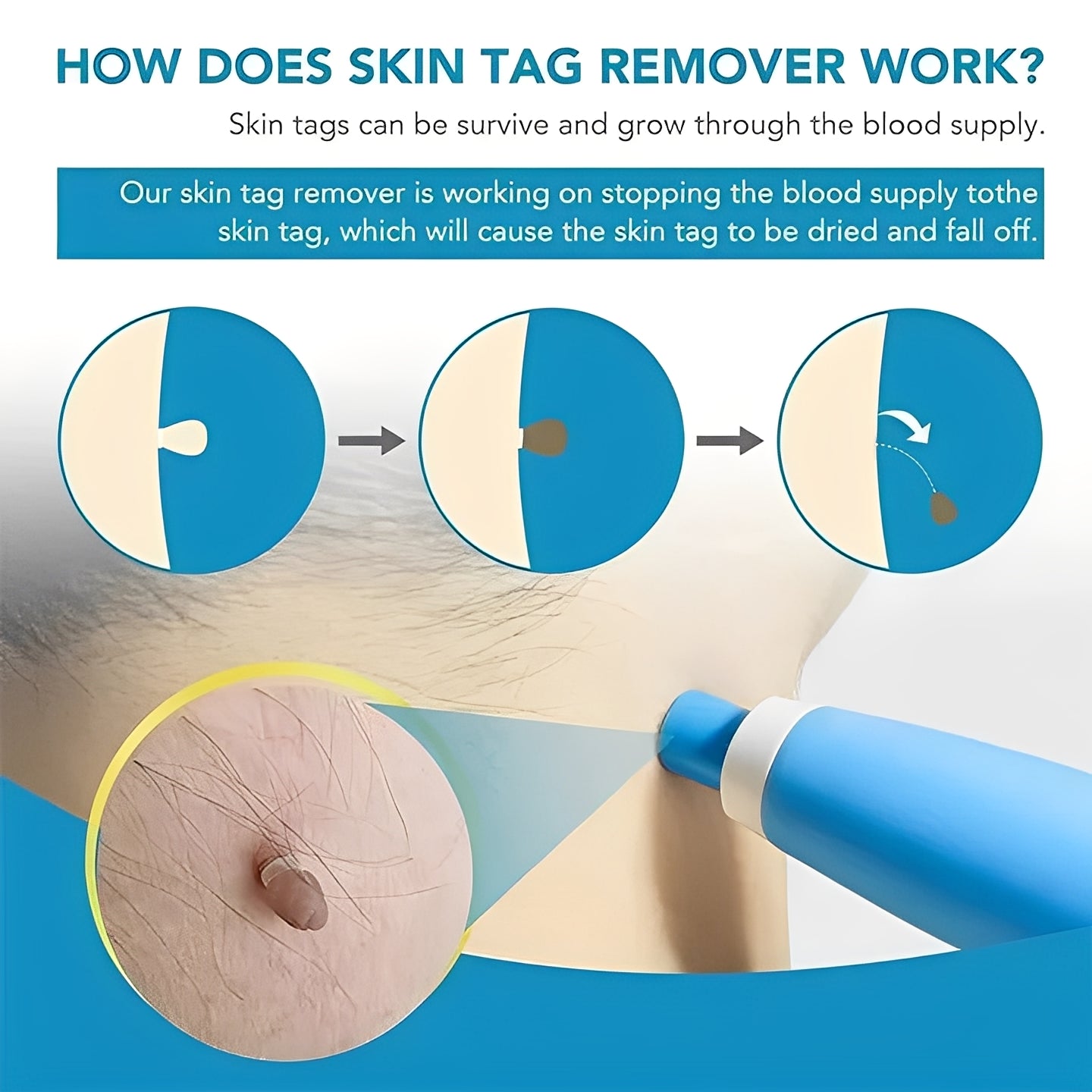 Advanced Skin Tag Removal Kit with Precision Applicator