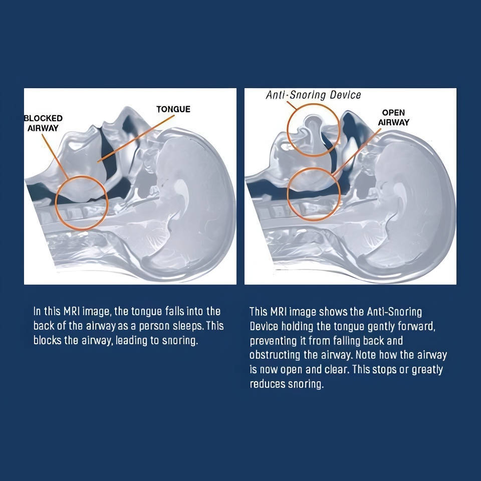 Non-Invasive Tongue Retainer for Snoring and Sleep Apnea Relief
