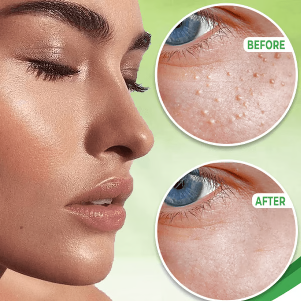 Gentle Milia Treatment for Radiant Skin Around Your Eyes